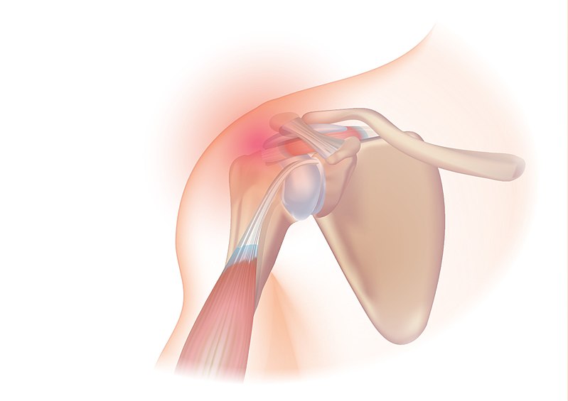 Penyebab, Gejala, dan Pengobatan - Rotator Cuff Tendinitis